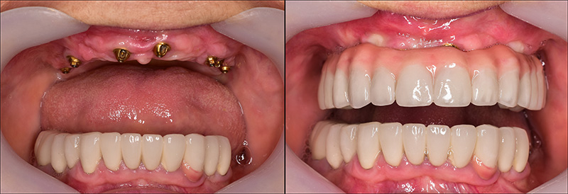 Implant Overdentures And Fixed All On X Treatment Ogden Dental 